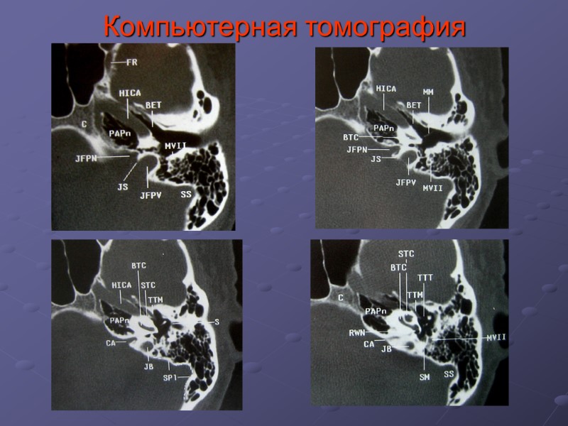 Компьютерная томография